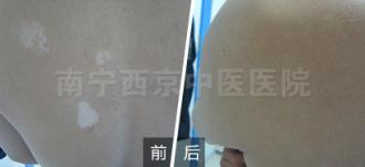 解读黑色素细胞培植术,治疗效果如何?