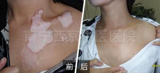 解读黑色素细胞培植术,治疗效果如何?